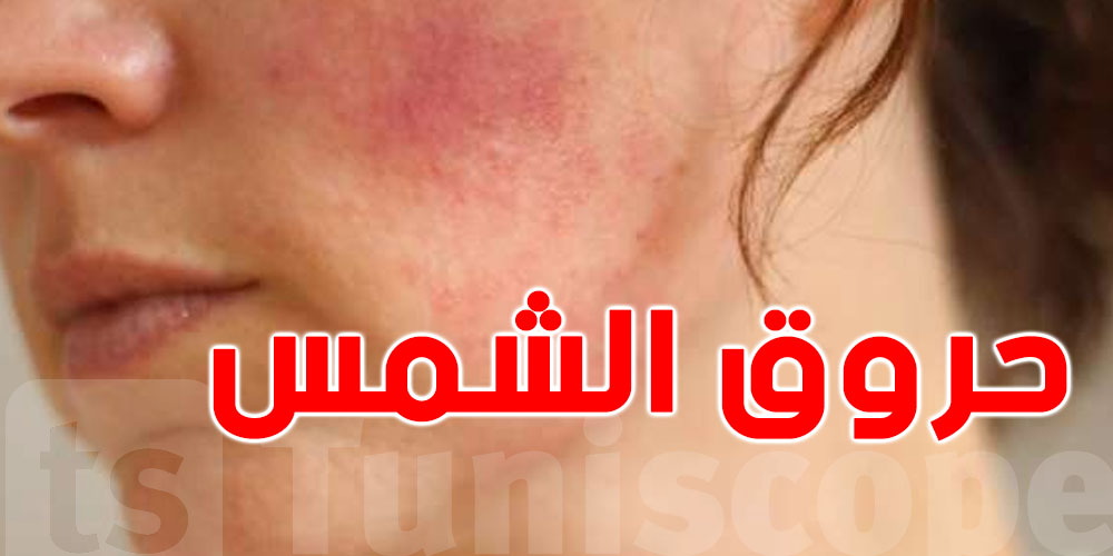 حروق الشمس: ليست مجرد إزعاج بل خطر طويل الأمد