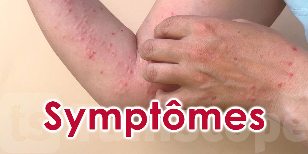 6 symptômes qui indiquent que vous êtes atteint de la variole du singe 