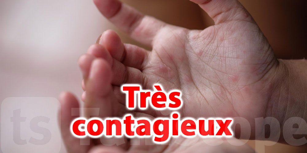 Chez les enfants, plusieurs cas de syndrome pieds-mains-bouche 