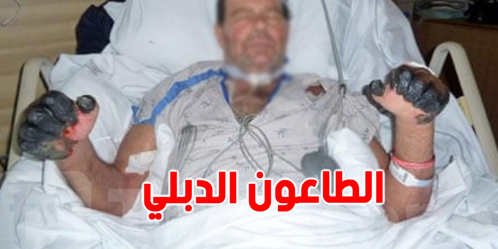 بعد تسجيل الصين إصابة بالطاعون الدبلي: ماذا قالت الصحة العالمية؟ بعد تسجيل الصين إصابة بالطاعون الدبلي: ماذا قالت الصحة العالمية؟