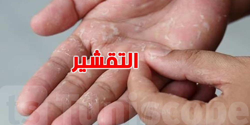 تقشّر اليدين والقدمين في السخانة: ردّ بالك موش حاجة عادية!