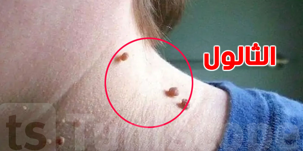 ''الثولال'': شنوّة هي وكيفاش ينتقل؟