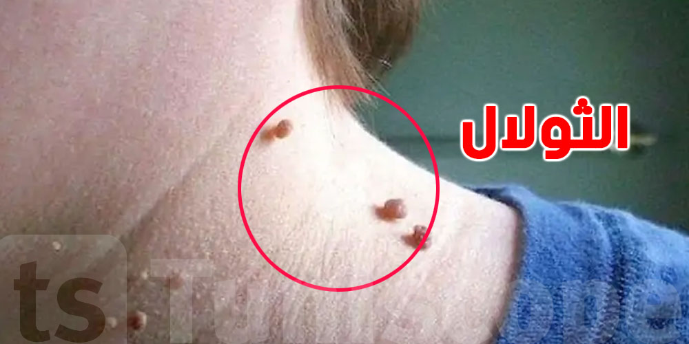 ''الثولال'': شنوّة هي وكيفاش ينتقل؟