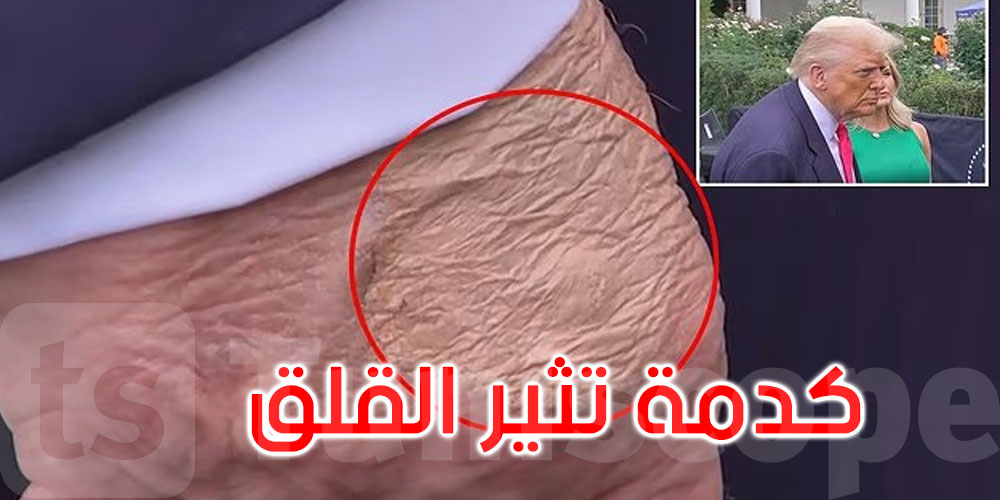.. كدمات على يد ترامب.. البيت الأبيض يكشف السبب ويُوضح حالته الصحية