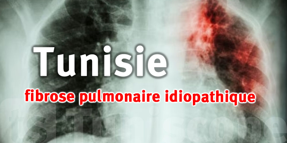 La Tunisie enregistre entre 100 et 150 nouveaux cas de fibrose pulmonaire idiopathique par an