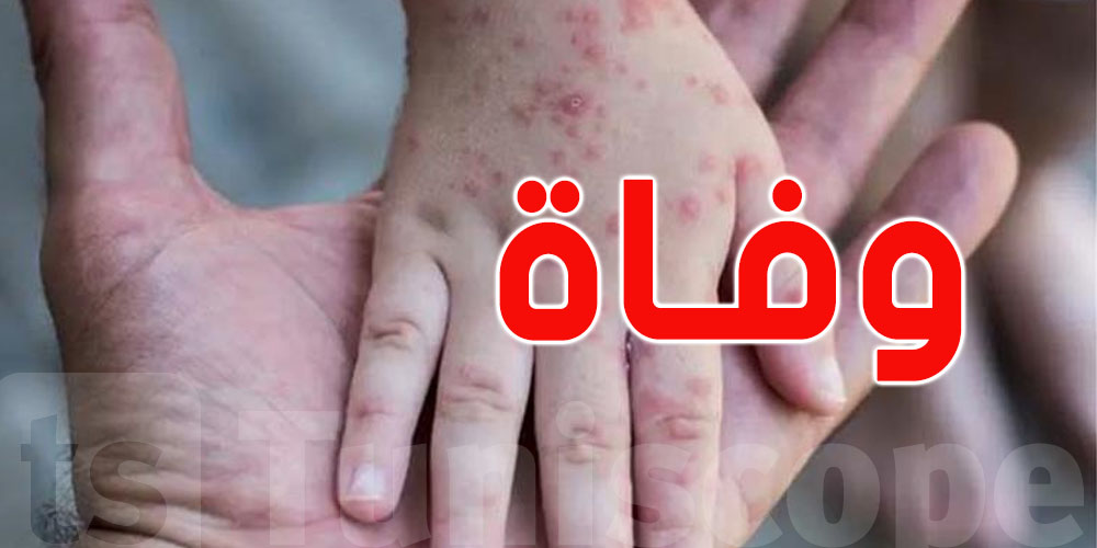 إسبانيا تُسجّل أوّل وفاة بجدري القردة إسبانيا تُسجّل أوّل وفاة بجدري القردة