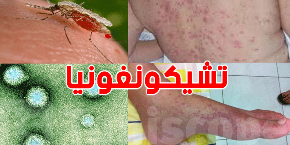 منظمة الصحة العالمية تحذّر من خطر تفشي فيروس شيكونغونيا من جديد...هذه أعراضه