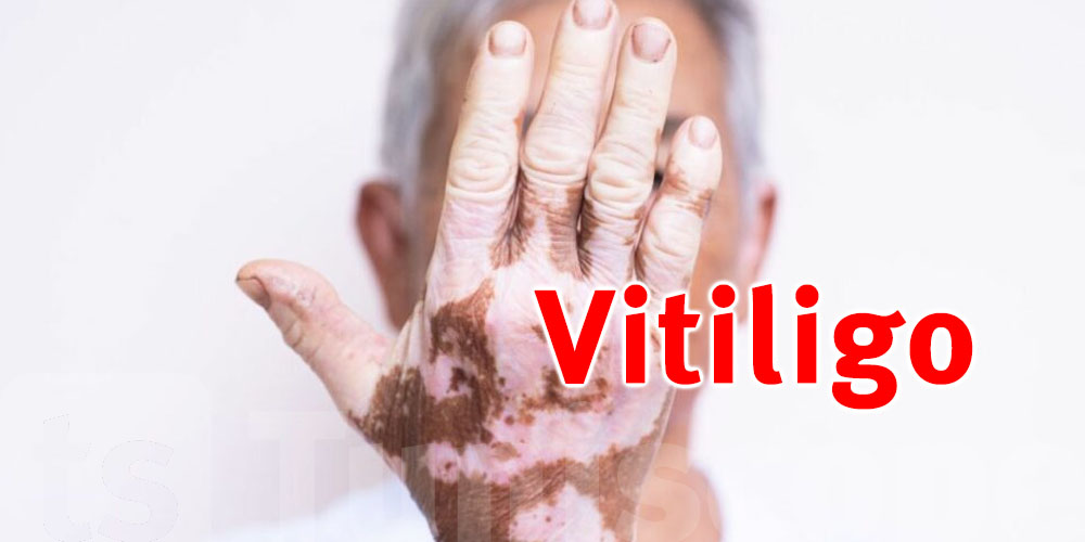 D'où vient le vitiligo et est-il contagieux ?